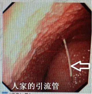 胸腔积液红色图片