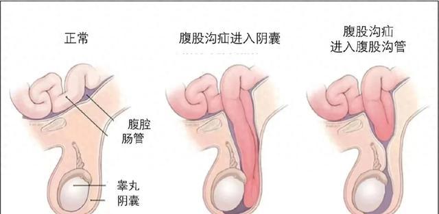 女性阴囊炎图片肿大图片