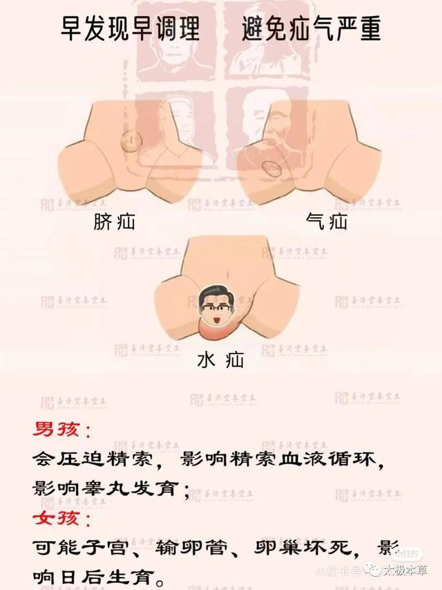 疝气不治会有什么后果图片