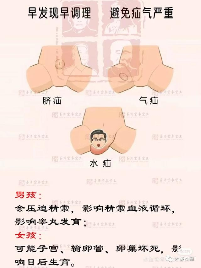 2·指阴囊硬结,肿痛.由寒邪袭于厥阴经所致.1.
