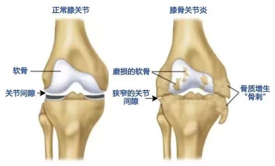 滑车关节面图片