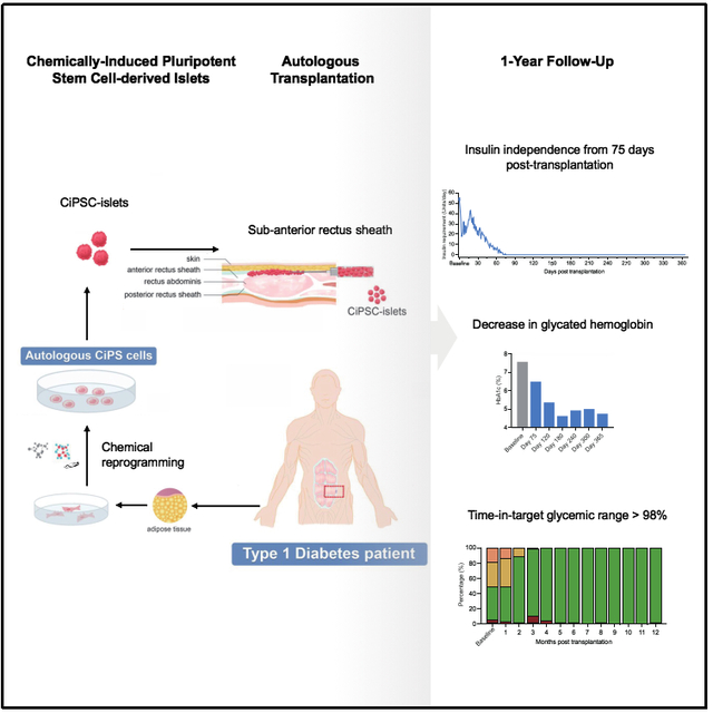 基于化学重编程诱导多能干细胞治疗1型糖尿病的临床研究的示意图和治疗效果（图片源自网络）
