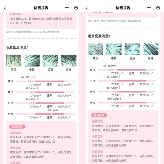 晖先生植发前与植发后近6个月毛发对比情况。受访者供图