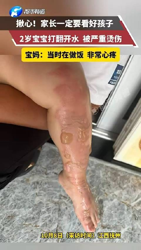 2岁宝宝打翻开水壶严重烫伤满腿水泡