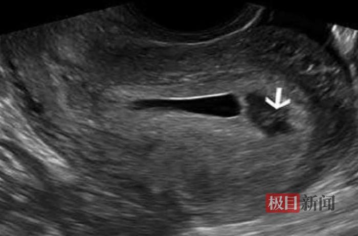 孕妈腹胀就医竟是先兆流产，竟和这个行为有关，医生紧急提醒！