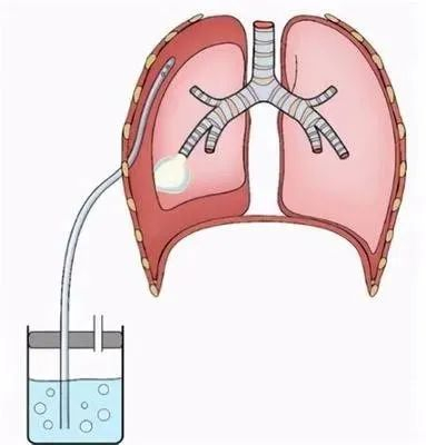 胸腔闭式引流术