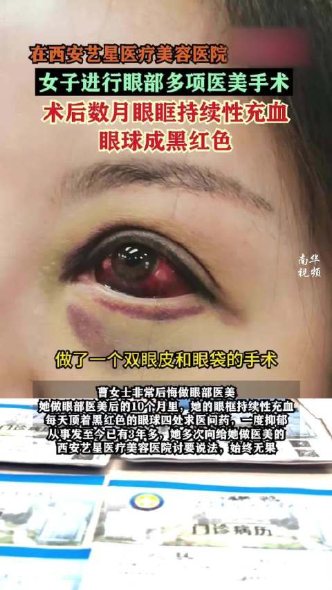 女子割双眼皮眼球持续充血呈黑红色