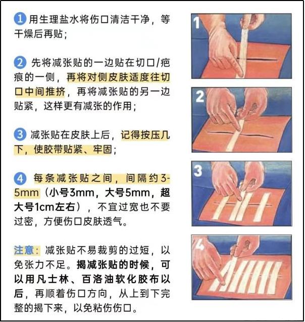 减张缝合拆线方法图解图片