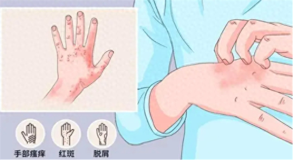 中医文献中记载的"浸淫疮