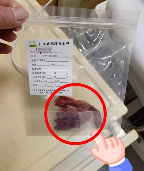 腹腔镜切除输卵管图片