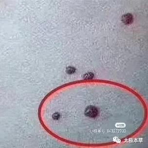 血痣,不用怕!咱老百姓有验方|外科|外科正宗|山栀|玄参|地黄_新浪新闻