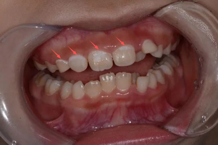 避免酸性物质(如糖类)长期浸泡牙面,以及定期涂氟来促进牙齿"再矿化"