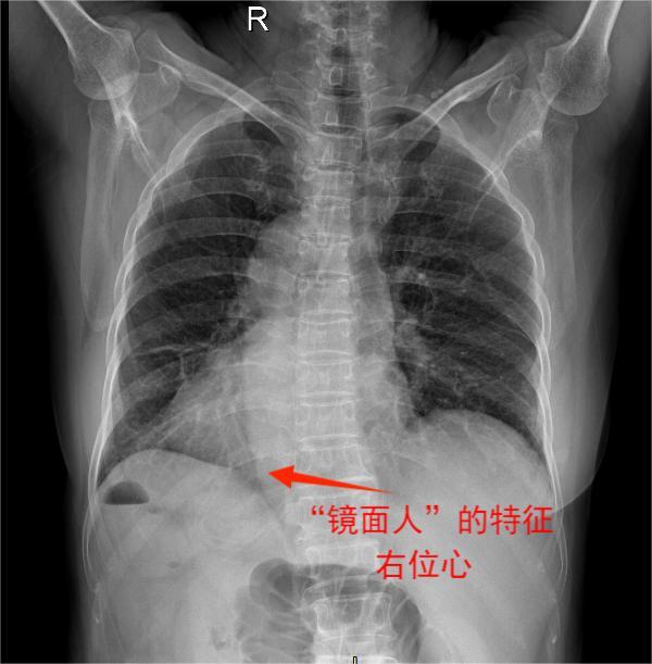 结肠癌x线图片图片