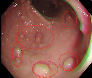 良性肠息肉图片直肠图片