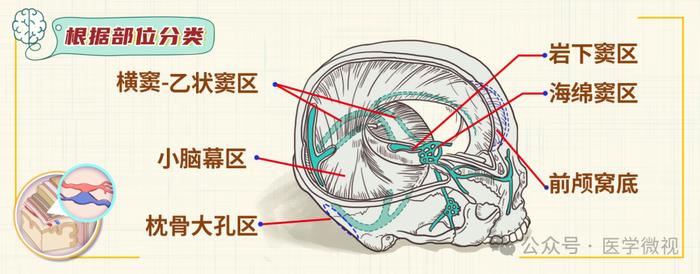 横窦乙状窦图片