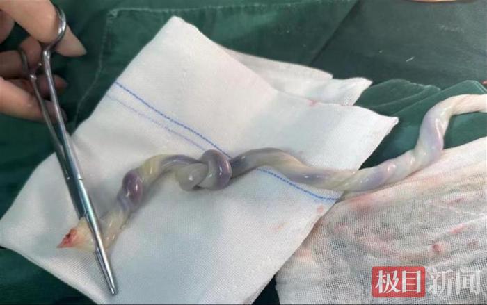 肚子里的宝宝突然安静了许多，原来是脐带打了个结，经医生紧急手术母子平安