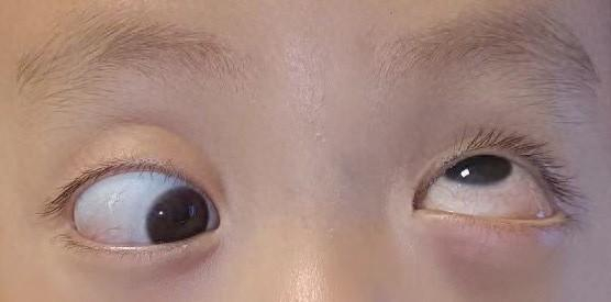 缺失眼外肌导致难以注视前方,罕见斜视患儿在沪治疗终能正常视物