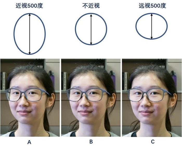 近视眼与正常眼睛外观图片