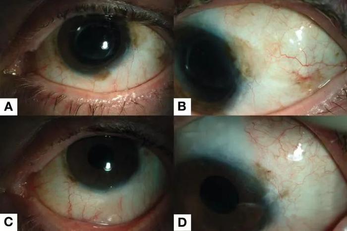 瞳孔有白斑图片