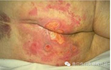 失禁性皮炎?压疮?两者怎么鉴别?