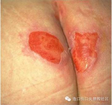 失禁性皮炎?压疮?两者怎么鉴别?