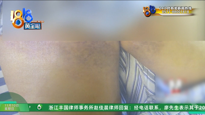 女子整容后肿得像外星人?她还提到了软禁、拖行、扇巴掌(图17)