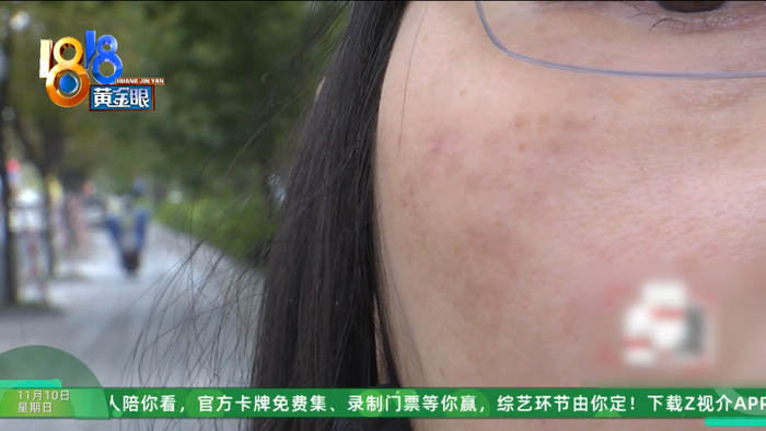 女子整容后肿得像外星人?她还提到了软禁、拖行、扇巴掌(图3)