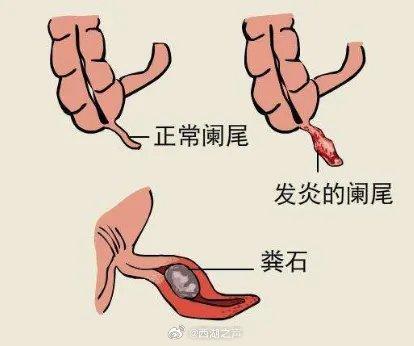 一天呕吐五六次，竟是肚中这条“蚯蚓”作祟，专家提醒：一经确诊危及生命！