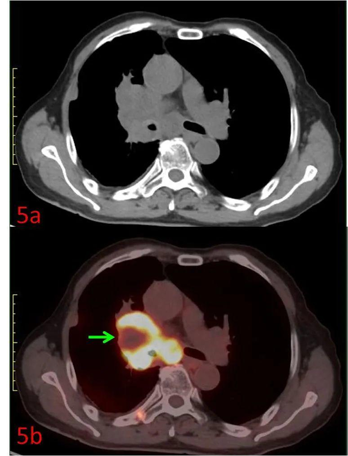 健康科普 | 发现肺癌，为什么要做PET/CT|手术|肿瘤|恶性肿瘤|肺部疾病|根治性_新浪新闻