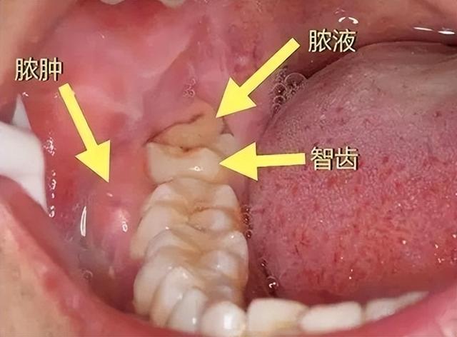 智齿冠周炎知识科普:守护口腔健康的小贴士