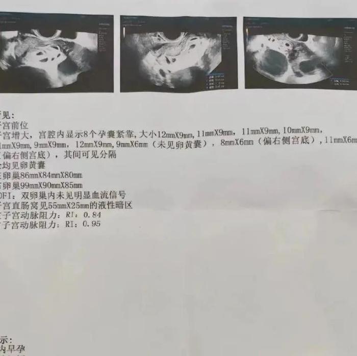 怀9胞胎女子进行减胎手术：分两次进行