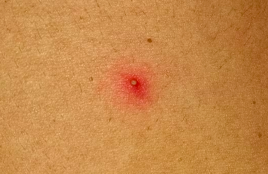 发于其他部位的毛囊炎丨mayoclinic.org