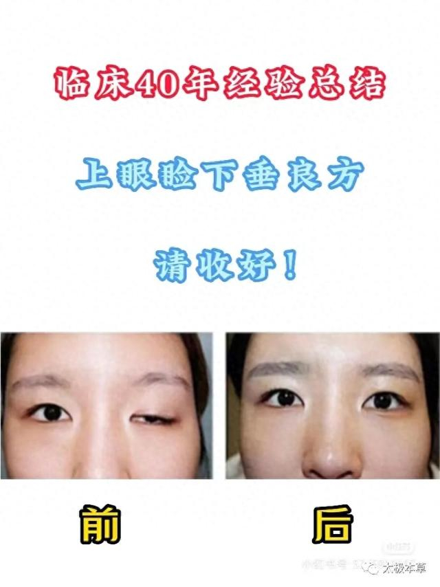 重症肌无力之眼睑下垂,不用怕!中医能治