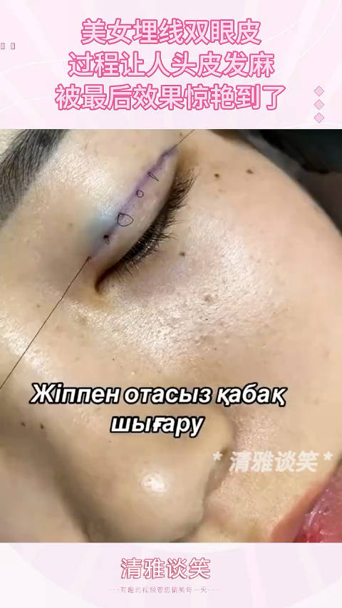 美女埋线双眼皮,过程让人头皮发麻,被最后效果惊艳到了!