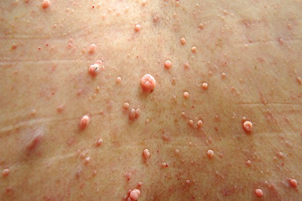 如果仅是皮肤型神经纤维瘤,那就是难看点,基本没啥恶化的危险,如下图