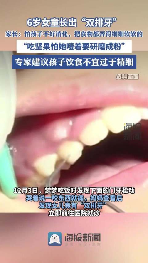 6岁女童吃得太精细长出双排牙 吃坚果都要研磨成粉
