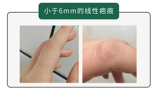 为什么很多人左手食指上都有道疤？