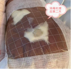 留置针怎么贴膜留置针拔除第二天就化脓了!这些细节一定要处理好!_新闻资讯_第4张_活检穿刺产品网 留置针怎么贴膜留置针拔除第二天就化脓了!这些细节一定要处理好!_https://www.jmylbn.com_新闻资讯_第4张