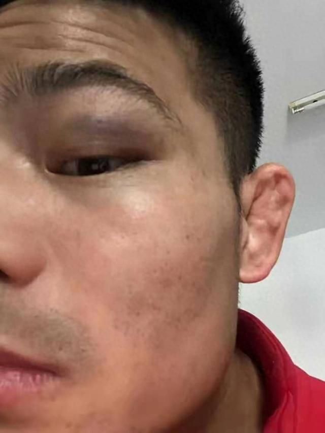 王亲亲被打后照片