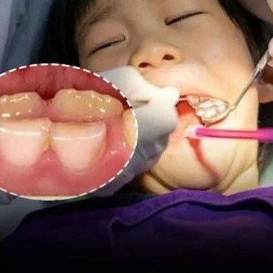 6岁女童竟长出“双排牙”！医生提醒：别这样给娃吃水果了，真的对牙不好