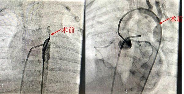 主动脉弓缩窄手术图片