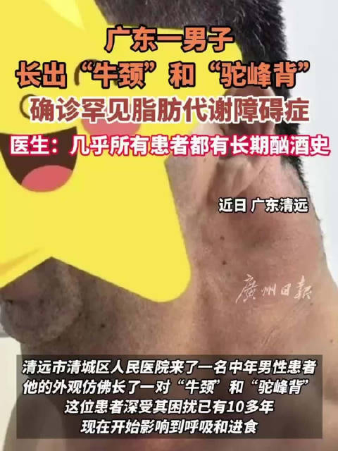 男子长出牛颈驼峰背确诊罕见马德龙病