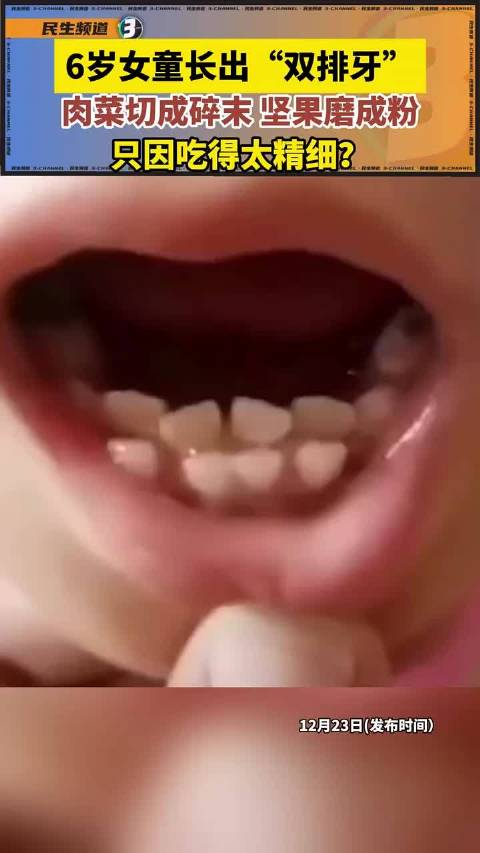 6岁女童长出"双排牙",肉菜切成碎末,坚果磨成粉,只因吃得太精细?
