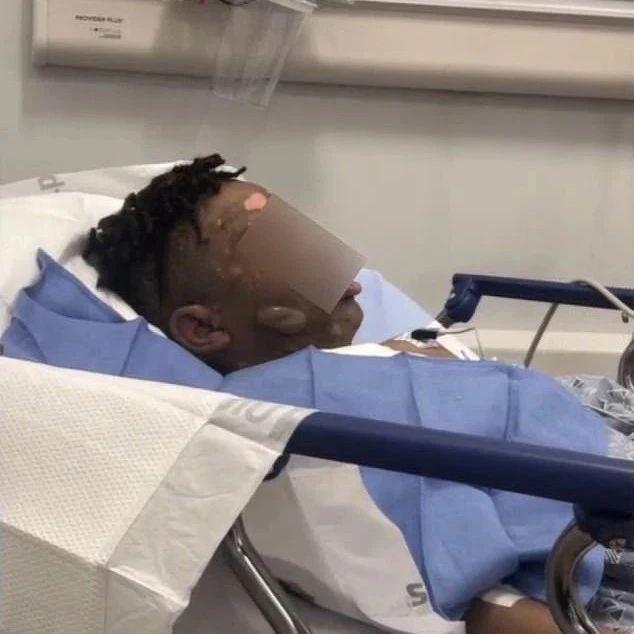 在“朋友”家住了一晚，12岁男孩被开水浇脸毁容！同学辩：恶作剧而已...