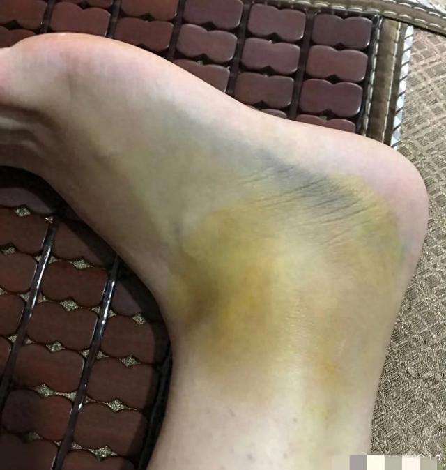 三黄南星膏治疗闭合性软组织损伤效果好