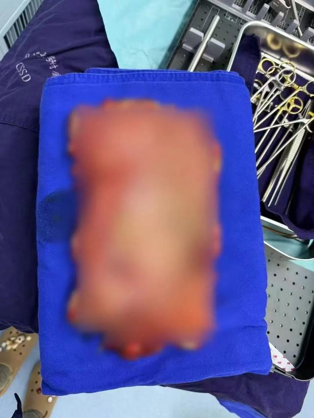 患者切除的全胃 图片来源：南通大学附属医院微信公众号