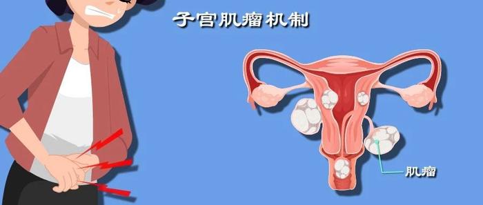 子宫肌瘤是咋把胎儿挤丢的？流产和不孕都是谁的错？备孕必读