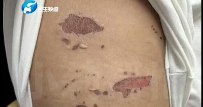 3岁男童吃火锅烫嘴后，全身溃烂！碰一下都很疼，医生：有传染性