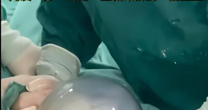 产妇生下“带壳”宝宝到底咋回事？有啥好处？了解一下涨知识