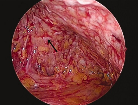 ✦•✦腋臭的来源是上文提到的大汗腺,不饱和脂肪酸e